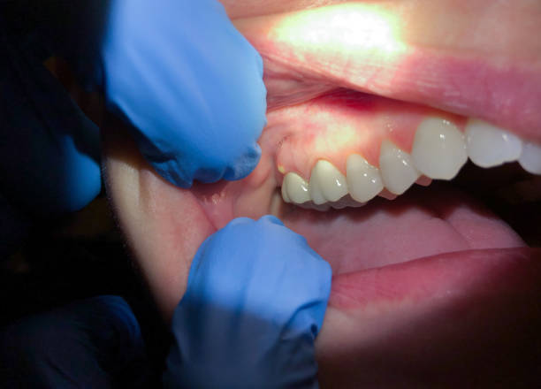 Best Emergency Treatment for Oral Infections in Freedom, CA