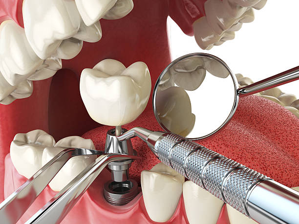 Best Broken or Chipped Tooth Repair in Freedom, CA